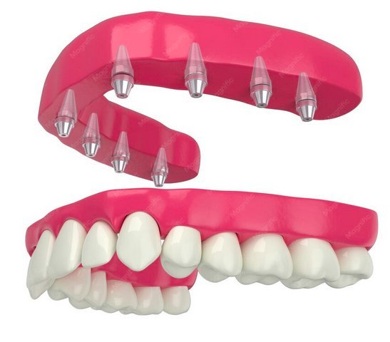 All-on-6: prótesis fija sobre 6 implantes